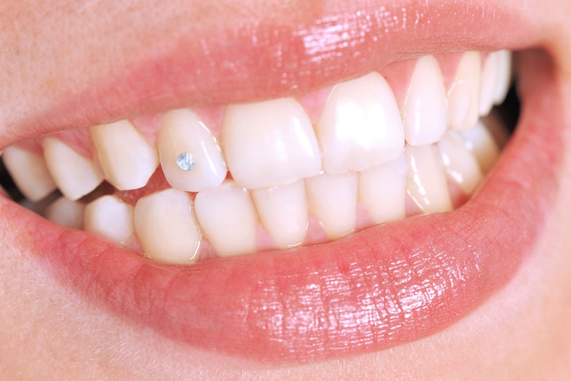 Tooth Jewellery Ardmore Dental Clinic