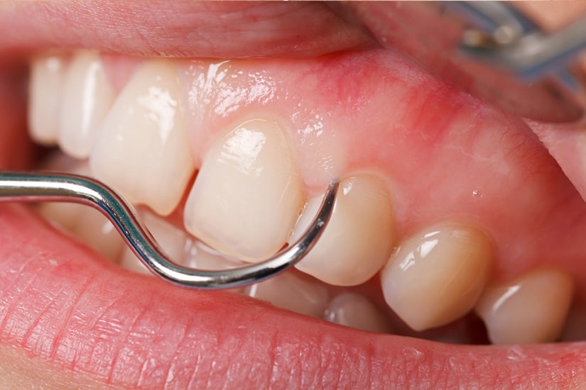 Gum Treatment Ardmore Dental Clinic