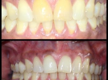 Dental bleaching