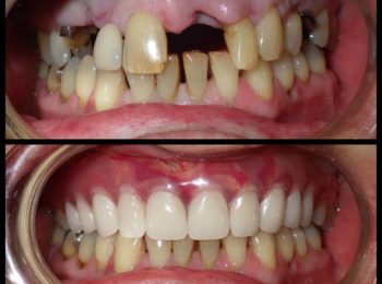 immidate upper denture