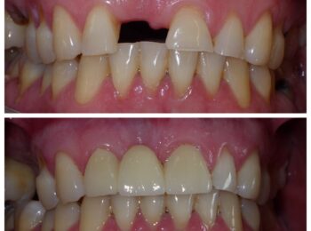 Ardmore Dental Anterior Bridge