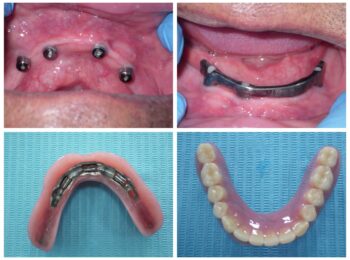 implant supported denture