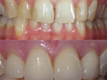 Ardmore Dental_Crown