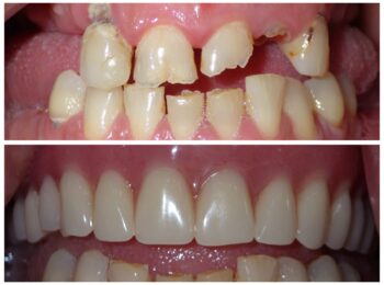 Ardmore Dental_Denture