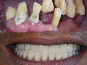 Ardmore Dental_Full Denture