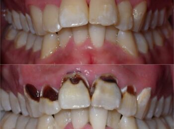 Ardmore Dental_Restoration