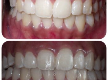 ardmore dental dr chandar Before and After